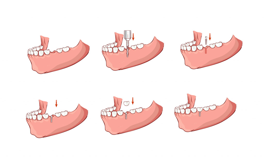 Имплантация зубов 2