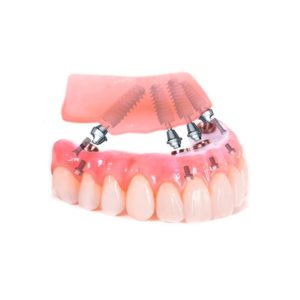 Съемное протезирование зубов 5