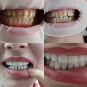 Реставрация зубов 2